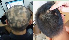 脂溢性脱发症状有哪些